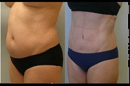 best liposuctionin ISLAMABAD