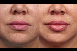 best lips botox price in ISLAMABAD