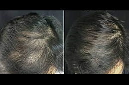 best mesotherapy-for-hair-loss in ISLAMABAD