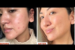best microneedling for acne scars in ISLAMABAD