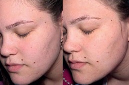 best microneedling for acne scars treatment in ISLAMABAD