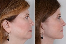 best neck-lift in ISLAMABAD