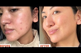 best radio frequency for acne scars in ISLAMABAD