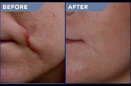 best scar-removal in ISLAMABAD