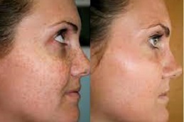 best skin brightening facial treatment in ISLAMABAD