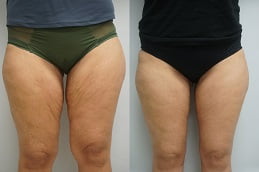 best thigh-lift-treatment in ISLAMABAD