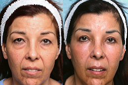 eye-bag-removal Clinic in Islamabad