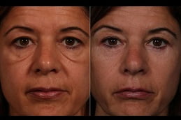 eye-bag-removal-in-ISLAMABAD