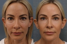 eye-bag-removal in rAWALPINDI