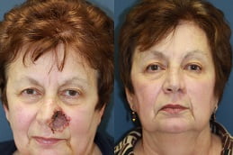 facial-scar-revision in ISLAMABAD