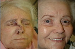 facial-scar-revision in rAWALPINDI