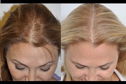hair-loss-treatment Clinic in Islamabad