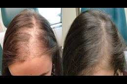 hair-loss-treatment in ISLAMABAD