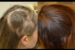 hair-loss-treatment in rAWALPINDI