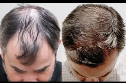 hair-transplant Clinic in Islamabad