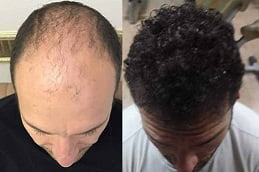hair-transplant in ISLAMABAD