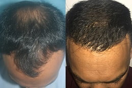 hair-transplant in rAWALPINDI