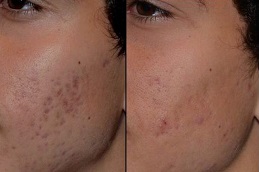 hypertrophic-scar-removal in ISLAMABAD