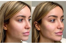 jawline-fillers-injections Clinic in Islamabad