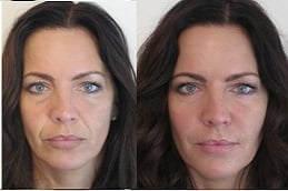 jawline-fillers-injections in ISLAMABAD