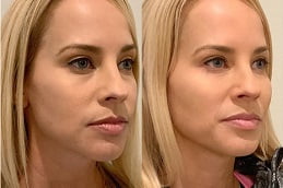jawline-fillers-injections in RAWALPINDI