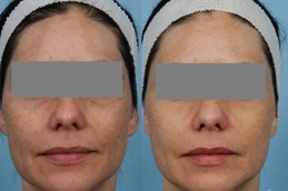 large-pores-treatment in ISLAMABAD