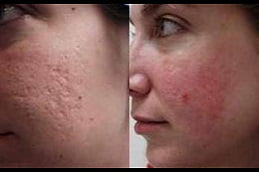 laser-acne-treatment Clinic in Islamabad