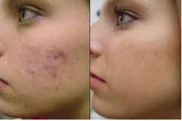 laser-acne-treatment in rAWALPINDI