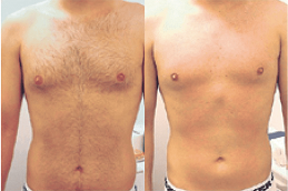 laser hair removal for men and women in ISLAMABAD