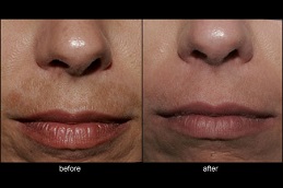 lip pigmentation treatment in RAWALPINDI