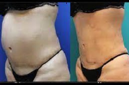 liposuction in ISLAMABAD