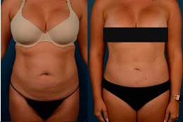 liposuction in rAWALPINDI