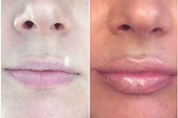 lips botox price in RAWALPINDI
