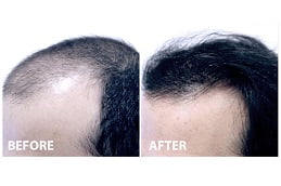 mesotherapy-for-hair-loss Clinic in Islamabad