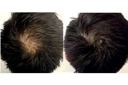 mesotherapy-for-hair-loss in ISLAMABAD
