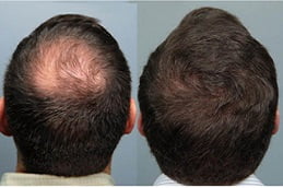 mesotherapy-for-hair-loss in rAWALPINDI