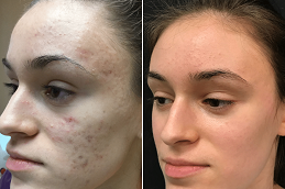 microneedling for acne scars Clinic in Islamabad
