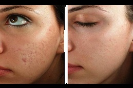 microneedling for acne scars in ISLAMABAD