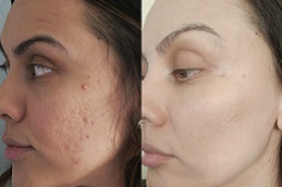 microneedling for acne scars treatment Clinic in Islamabad