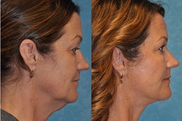 neck-lift Clinic in Islamabad