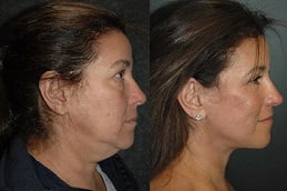 neck-lift in ISLAMABAD