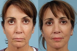 neck-lift in rAWALPINDI