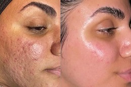 radio frequency for acne scars Clinic in Islamabad