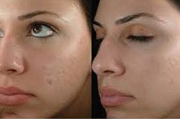 skin brightening facial treatment in ISLAMABAD