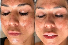 skin brightening facial treatment in RAWALPINDI