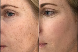 skin-laser-treatment-cost in RAWALPINDI