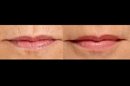  smokers-lips-treatment-Clinic-in-Islamabad