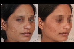 tan removal treatment in ISLAMABAD