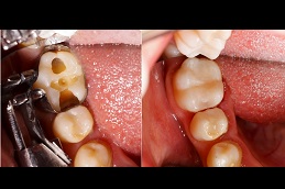 https://www.glamorousclinic.com.pk/wp-content/uploads/2022/10/teeth-filling-price-Clinic-in-Islamabad.jpg