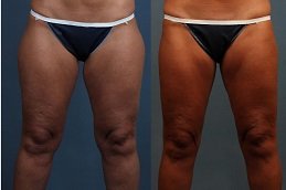 thigh-lift-treatment Clinic in Islamabad